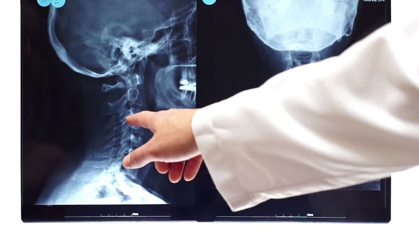 Spine Injuries from High Impact Accidents